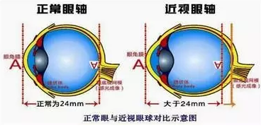 近視眼球突出？！控制近視度數(shù)加深是關(guān)鍵！