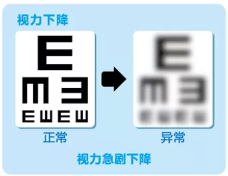 視網(wǎng)膜脫離啥癥狀？這張圖告訴你！