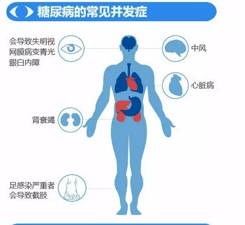 你造嗎？糖尿病晚期眼睛會致盲！