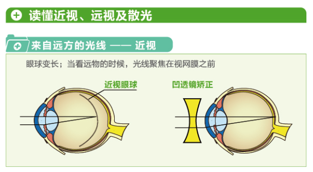 【看圖解】一張圖教你看懂近視、遠(yuǎn)視和散光