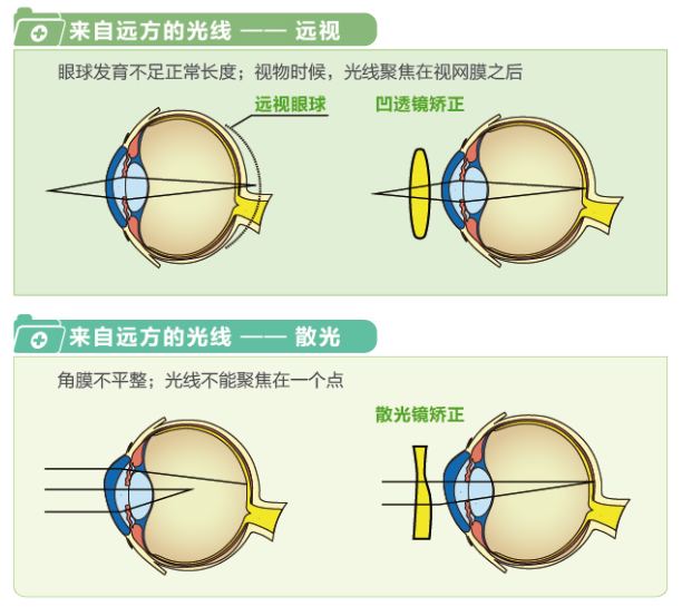 【看圖解】一張圖教你看懂近視、遠(yuǎn)視和散光