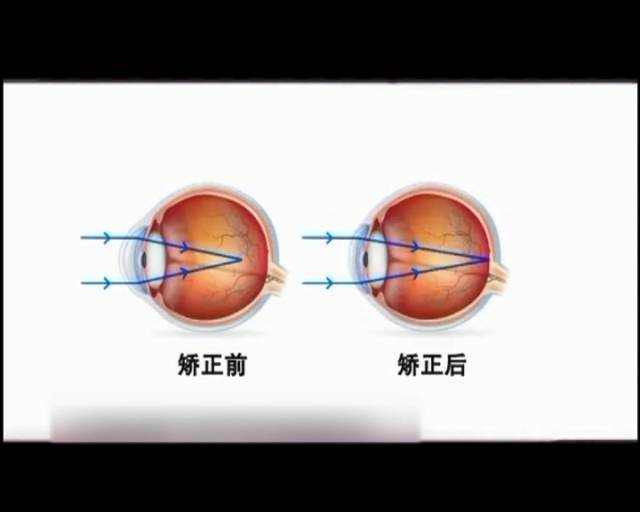 一夜之間真的能改變視力嗎？