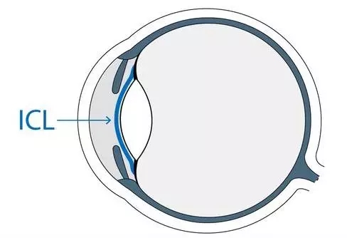 想做ICL晶體植入術(shù)，你需要了解的全在這里!
